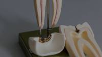 Root Canal Treatment